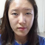 我是韩国原辰医院下巴截骨术亲身经历者,下巴前移后脸型变好了