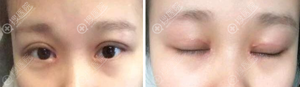 深圳鹏程吕美琪开眼角疤痕修复术后半个月效果图