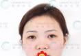 北京领医医疗美容员工用亲身体验告诉你崔相平做隆鼻子怎么样