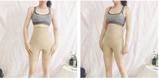腰腹环吸+大腿吸脂术后5天穿塑身衣效果