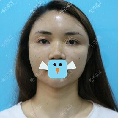 深圳丽港丽格谢俊全面部脂肪填充术后即刻效果 深圳丽港丽格谢俊全面部脂肪填充术后即刻效果