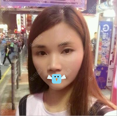 谢俊自体脂肪面部填充消肿后效果图 谢俊自体脂肪面部填充消肿后效果图