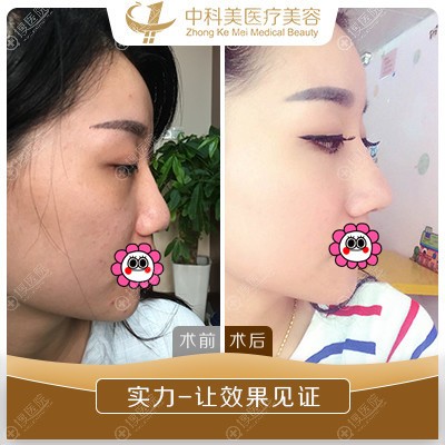 <!--<i data=20240710 data-id=11891></i>-->陈美运鼻综合案例