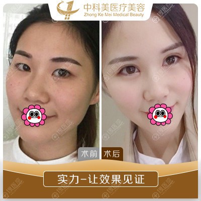 <!--<i data=20240710 data-id=11891></i>-->郑志敏双眼皮案例