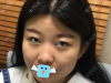 颜控找深圳米兰柏羽王志东做耳软骨复合隆鼻就因为塌鼻子不漂亮