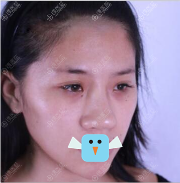 深圳美莱隆鼻术前照片