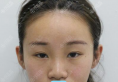 韩国清潭FIRST李丙玟双眼皮鼻综合整形案例分享术后对比效果图