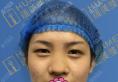 很幸运选择广州画美做耳软骨+韩国硅胶隆鼻恢复三个月整形案例