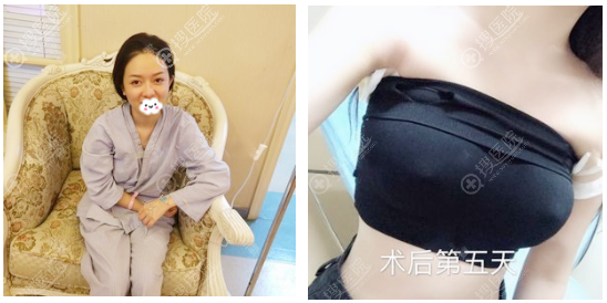 在上海伊莱美做假体隆胸术前照片