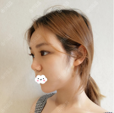在上海薇琳医美做鼻子术前照片