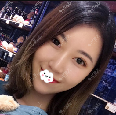 线雕术后20天恢复照片