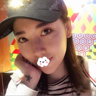 埋线提升术后4个月素颜照片