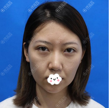 找<!--<i data=20240710 data-id=11938></i>-->韦婷做术前面诊