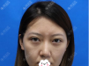 脸上皮肤下垂南宁贺尔美韦婷建议我做玻尿酸丰苹果肌+埋线提升