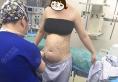 西安高一生张林宏做的腰腹吸脂手术案例一个月达到满意的效果