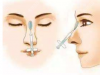 看过玻尿酸隆鼻术后护理方案与适宜人群才能放心做注射隆鼻