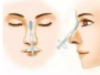 看过玻尿酸隆鼻术后护理方案与适宜人群才能放心做注射隆鼻