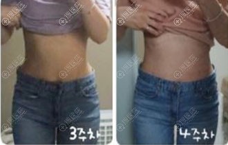 韩国365mc吸脂医院腰腹吸脂术后3-4周对比图