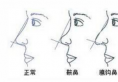 北京做鞍鼻整形的价格是多少钱，帮你了解鞍鼻有救吗该如何美化