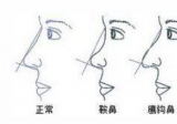 北京做鞍鼻整形的价格是多少钱，帮你了解鞍鼻有救吗该如何美化