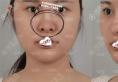 韩国ID整形医院肋骨隆鼻修复+面部溶脂+轮廓三件套案例恢复图