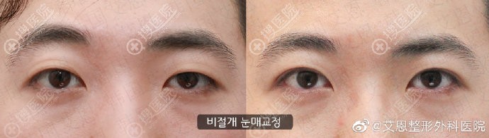 韩国艾恩双眼皮模糊修复