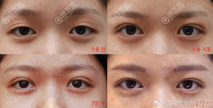 韩国艾恩多眼皮修复案例