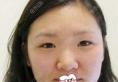 我在韩国ID整形医院做双眼皮+假体隆鼻+垫鼻尖手术价格不贵哦