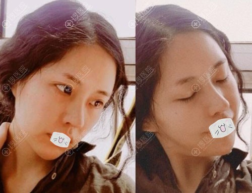 韩国Profile整形医院硅胶假体隆鼻+鼻尖整形案例