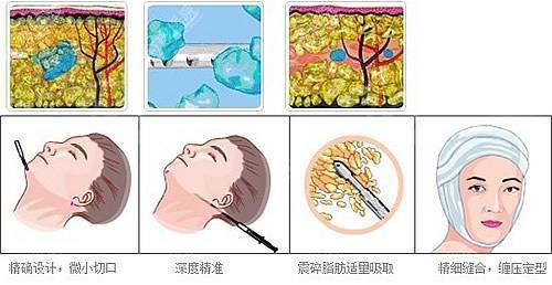 面部吸脂原理