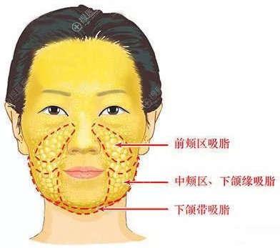 面部吸脂部位示意图