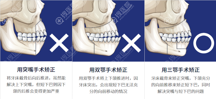三鄂手术可以同时改善凸嘴+短下巴的情况