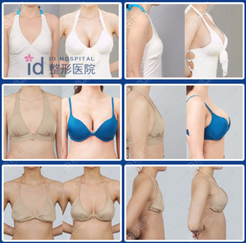 韩国ID整形医院假体隆胸真人案例前后对比图
