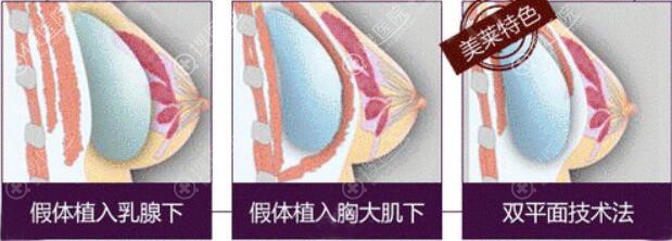 <!--<i data=20240710 data-id=11929></i>-->假体隆胸技术
