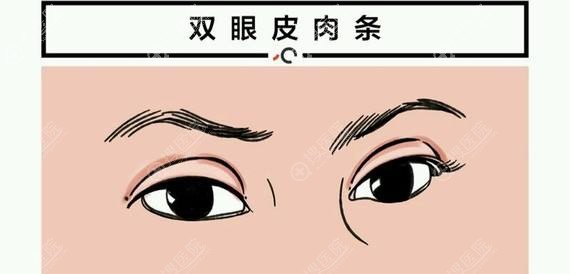 割双眼皮后为什么会出现肉条感
