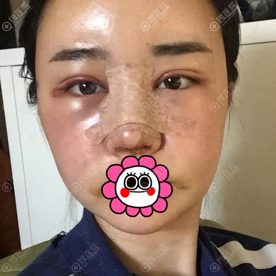 韩国爱婷金振星做鼻子眼睛面部填充术后三天