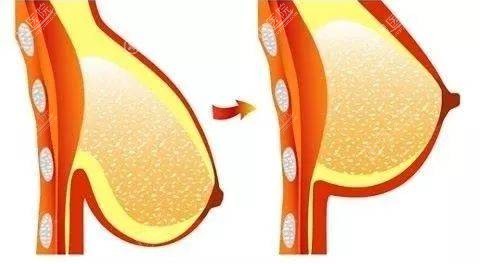 哺乳后胸部下垂松弛不如来试试这些改善的方法 整形美容行业新闻