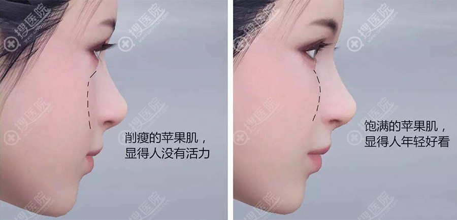 提升苹果肌效果怎么样
