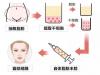 面部脂肪填充过量用维密6度脂雕修复效果怎么样？