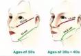 用埋线提升让面部原本松弛下垂的皮肤变的饱满紧致更显年轻