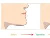 下巴前突侧脸难看，矫正的话需先分辨是骨性畸形还是反颌畸形