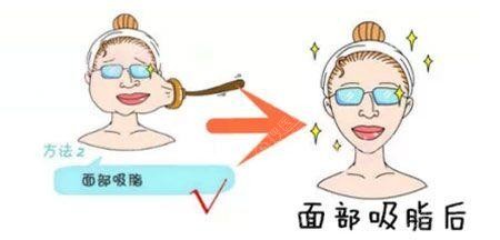 面部吸脂瘦脸