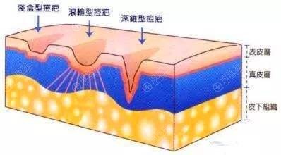 点阵激光治疗范围