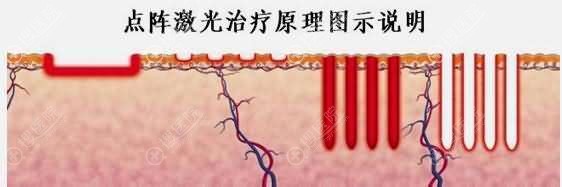 点阵激光原理示意图