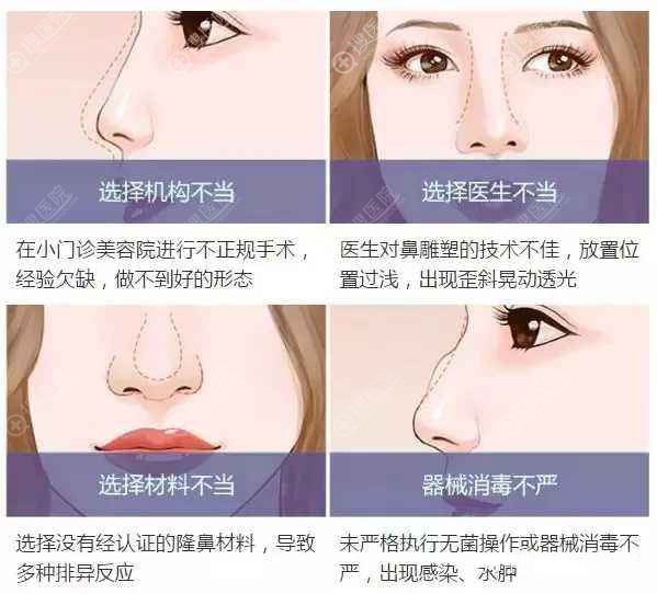 做了假体隆鼻后还不如原来的鼻子好看 想取出假体鼻子会变形吗 整形美容行业新闻资讯 搜医院 做了假体隆鼻后还不如原来的鼻子好看 想取出假体鼻子会变形吗 整形美容行业新闻资讯 搜医院