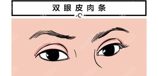 双眼皮出现肉条的原因？