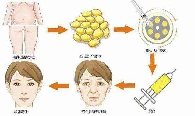 自体脂肪面部填充示意图