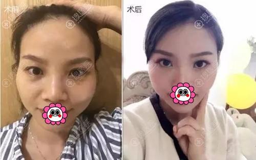 自体脂肪面部填充对比效果图