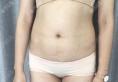 成都艾米丽潘红伟吸脂瘦腰腹恢复过程,两个月没有出现凹凸不平