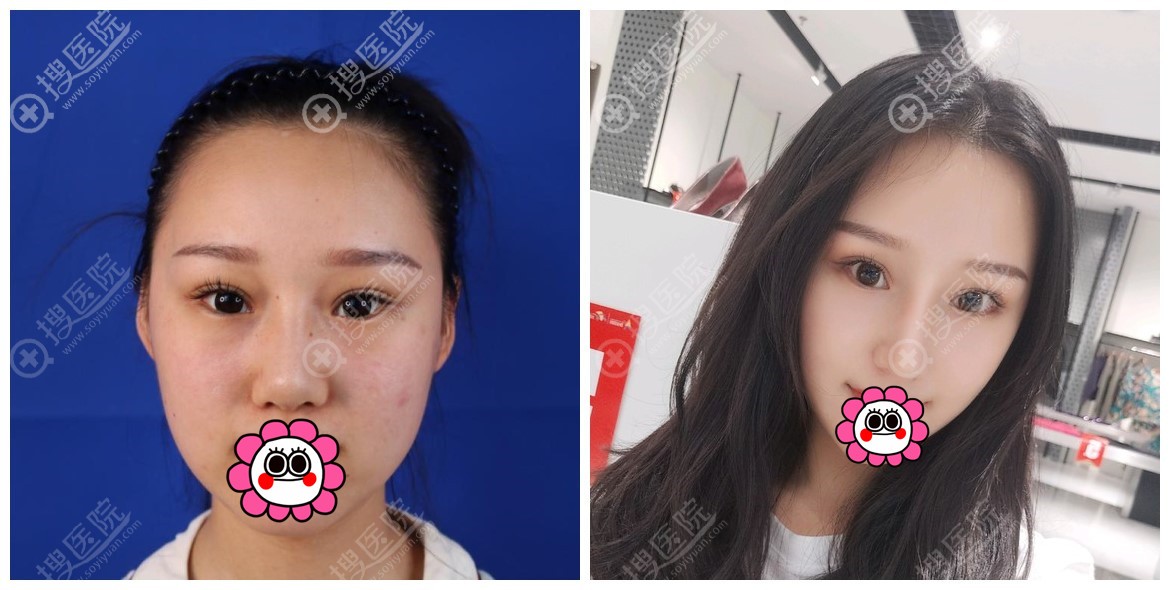 西安鼻综合有名的医生西安画美杨万忠做一个肋骨鼻大概多少钱 整形美容行业新闻资讯 搜医院 西安鼻综合有名的医生西安画美杨万忠做一个肋骨鼻大概多少钱 整形美容行业新闻资讯 搜医院